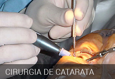 Cirugia de Catarata em Montes Claros